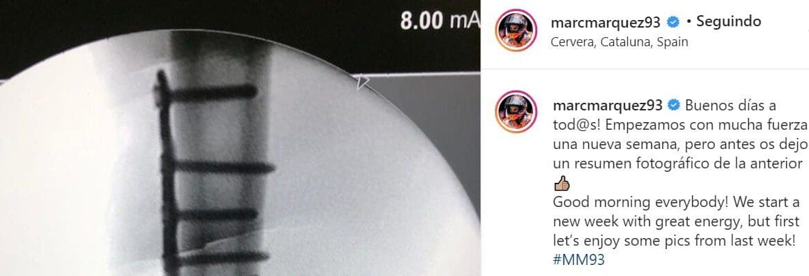 Márquez divulga imagens de fratura e operação via redes sociais